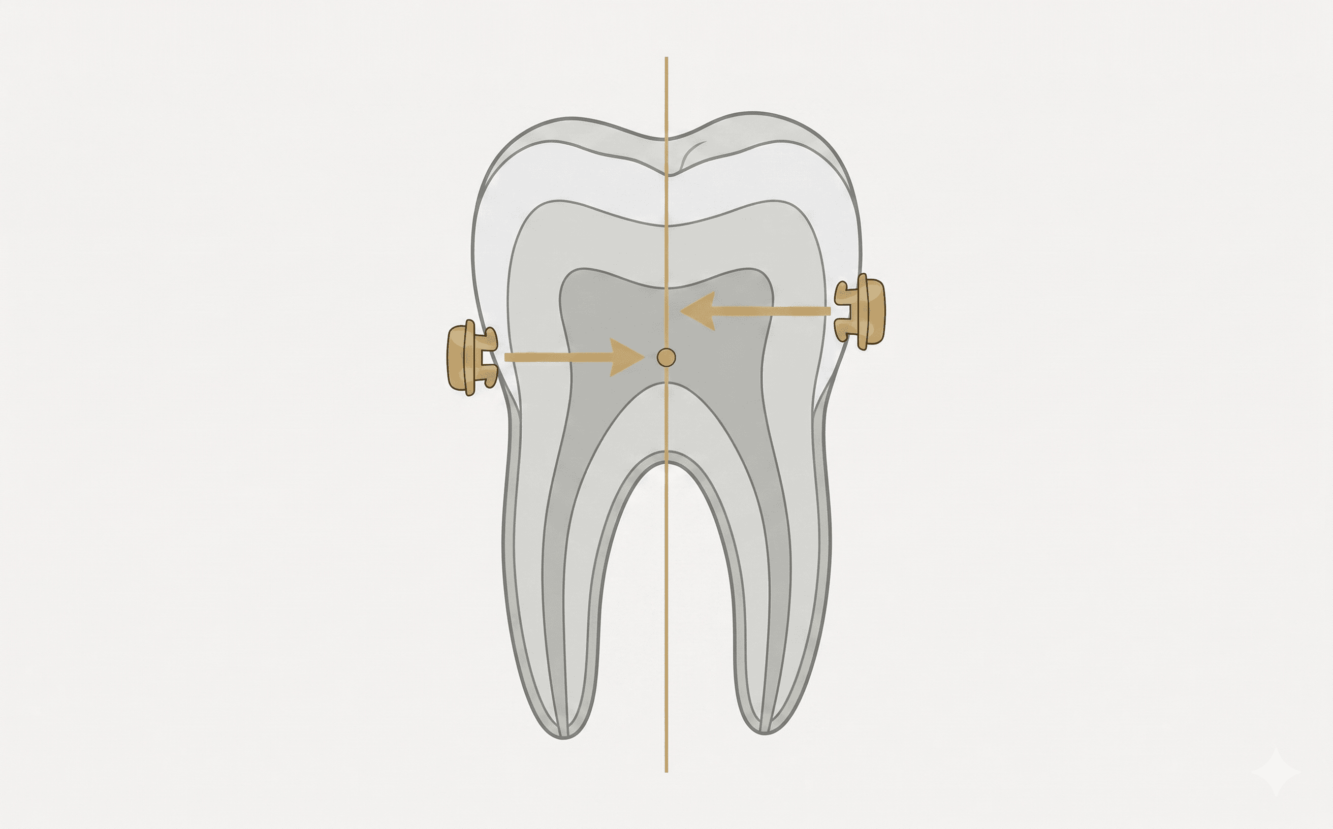 Los brackets linguales ofrecen un control biomecánico superior al estar más cerca del centro de resistencia del diente.