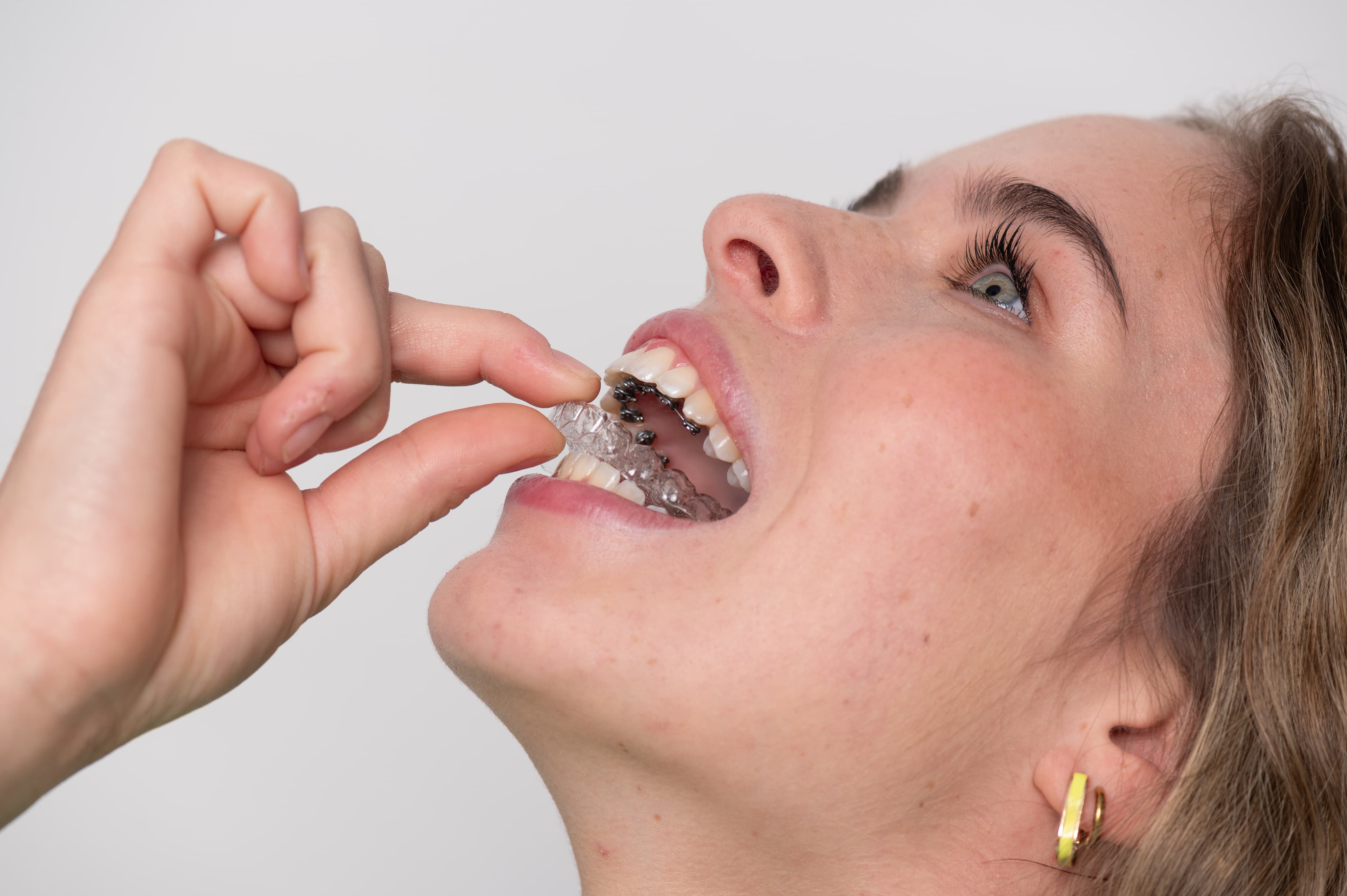 Tips para Comer con Alineadores sin Interrumpir tu Tratamiento