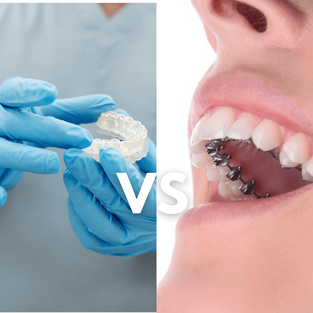 Alineadores vs Brackets Linguales: ¿Es la mejor opción para ti?
