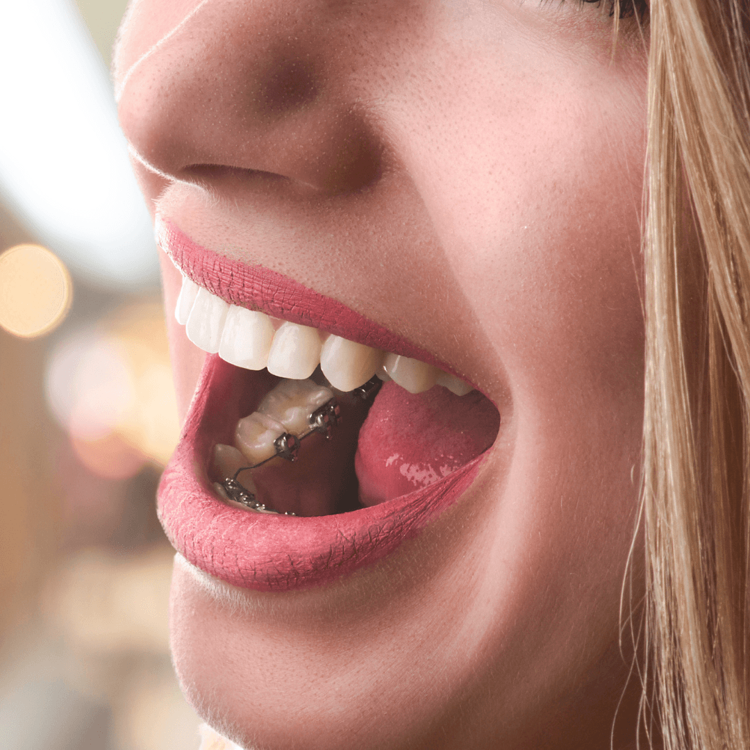 5 Beneficios de la ortodoncia lingual para adultos - Clinica Lingual